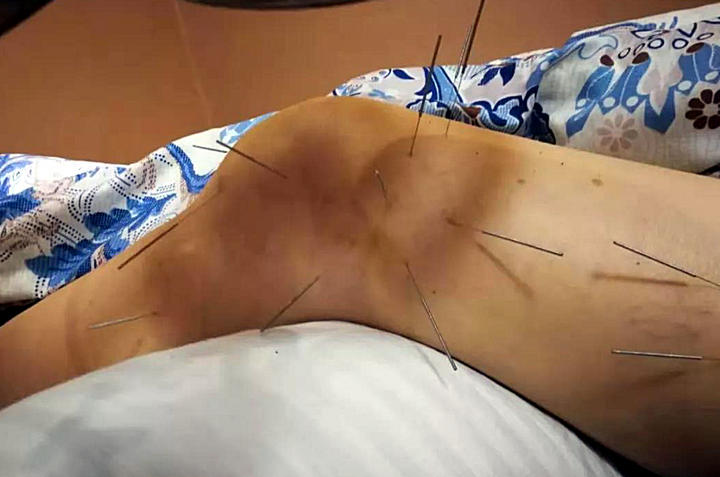针灸推拿 潘要治:髌周滑囊炎案例解析 二诊时肿胀疼痛感已有减轻,但